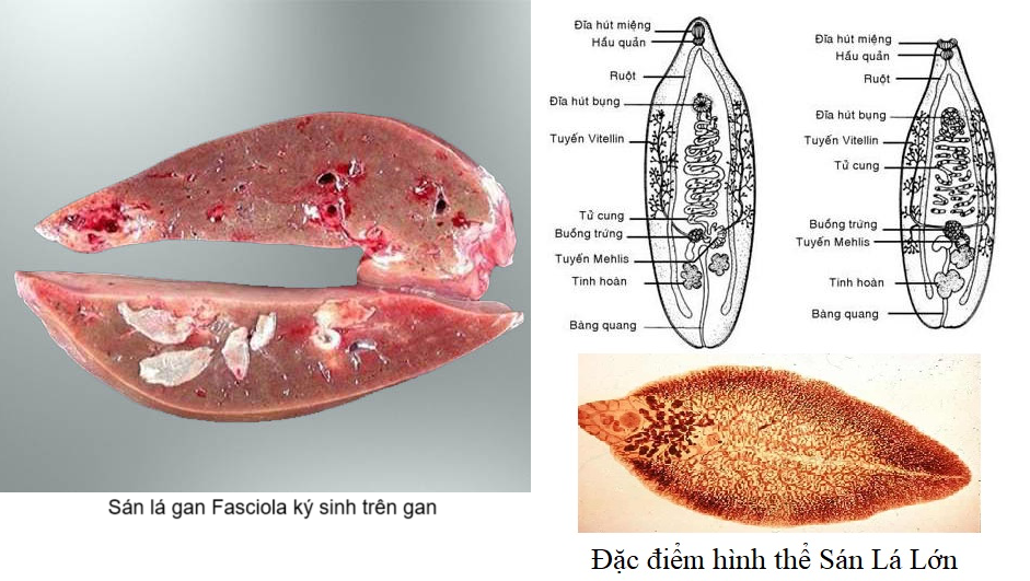 TÌM HIỂU VỀ BỆNH SÁN LÁ GAN LỚN Ở NGƯỜI